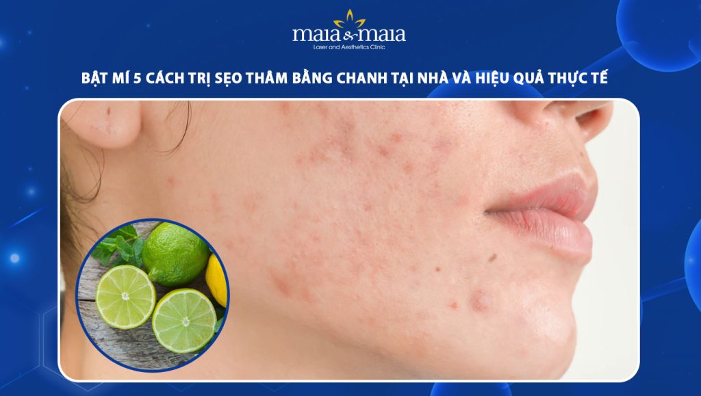 trị sẹo thâm bằng chanh