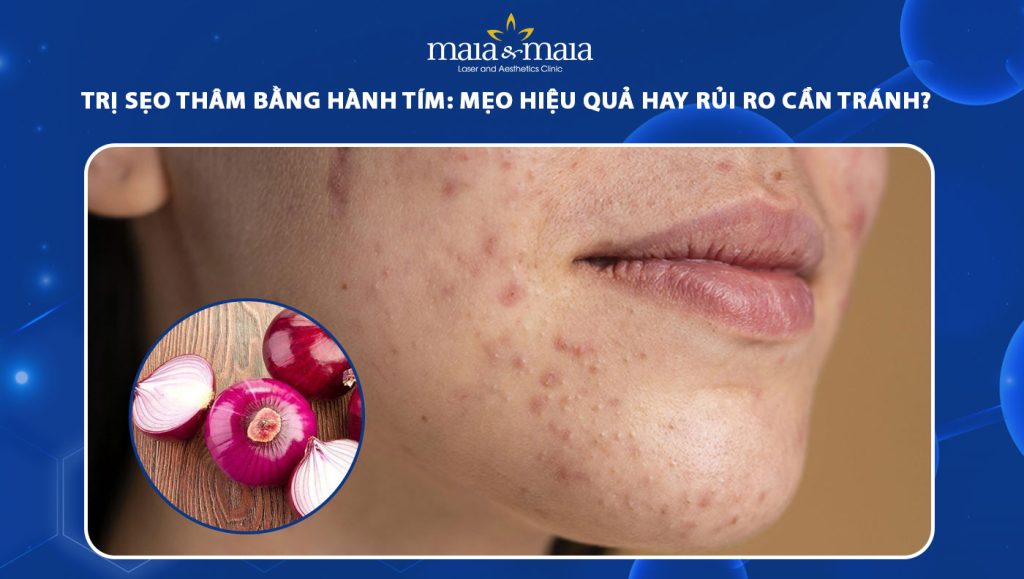 trị sẹo thâm bằng hành tím
