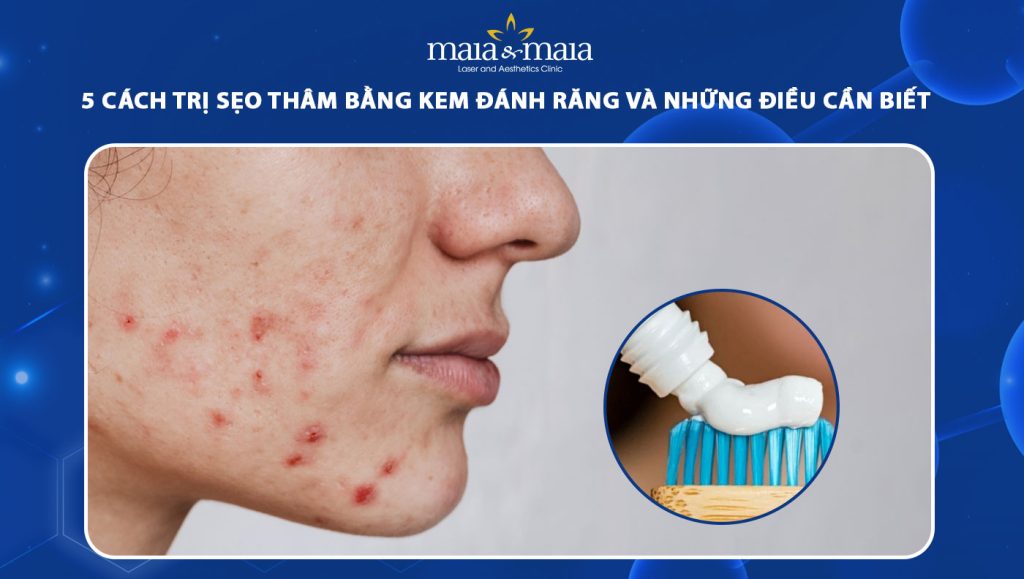 trị sẹo thâm bằng kem đánh răng