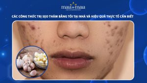 trị sẹo thâm bằng tỏi