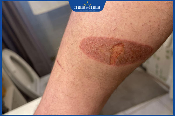 Lựa chọn thuốc trị sẹo bỏng bô hiệu quả theo từng giai đoạn 3 vết bỏng đang lành