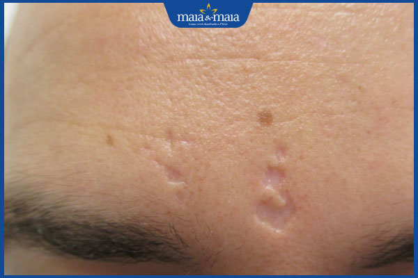 Sẹo lõm trên trán: Dấu hiệu nhận biết và phương pháp điều trị 2 vết lõm ở trán