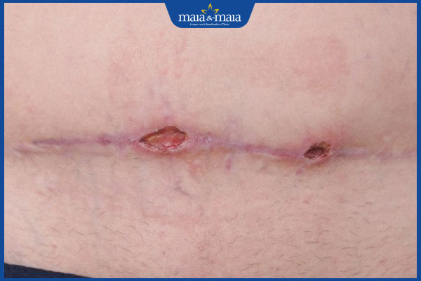 vết mổ bị viêm loét