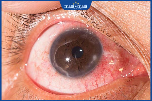 Sẹo giác mạc có nguy hiểm không? Cách chẩn đoán và điều trị 2 viêm loét giác mạc