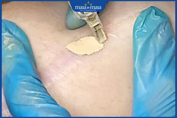 Xăm màu da che sẹo: Giải pháp hiệu quả hay rủi ro tiềm ẩn? 3 xăm che sẹo