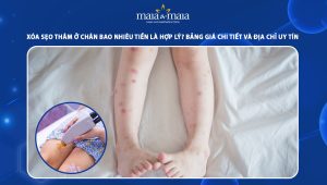 xoá sẹo thâm ở chân bao nhiêu tiền