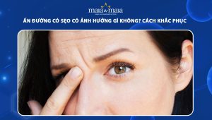 ấn đường có sẹo