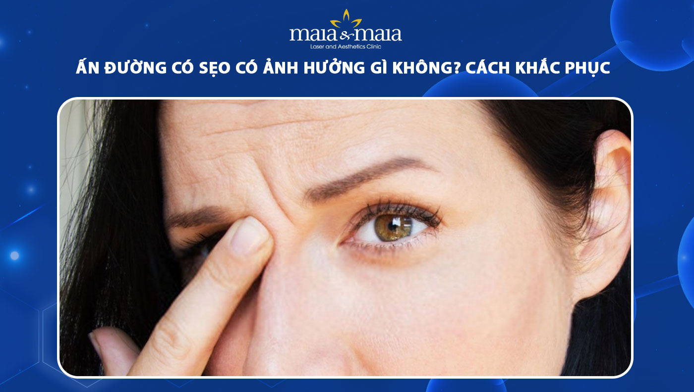 ấn đường có sẹo