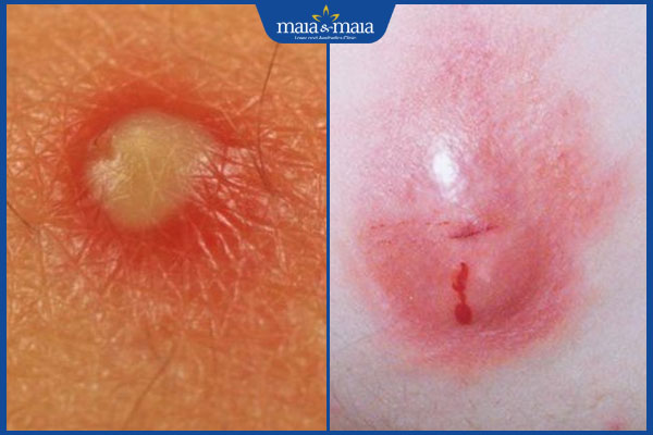 Cách phân biệt các dạng mụn trứng cá ở mông và hướng điều trị 2 các dạng mụn mông