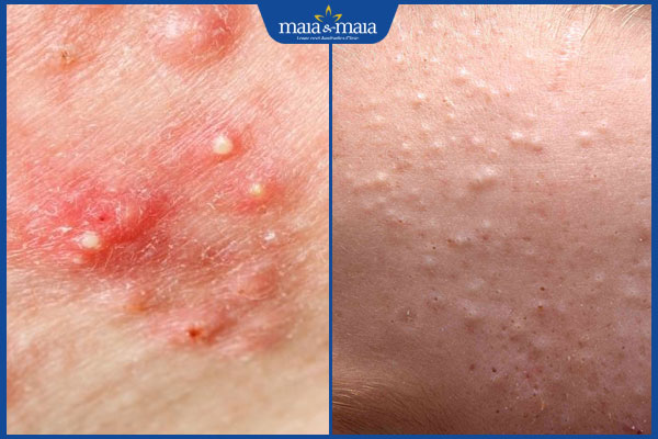 Mụn trứng cá có dấu hiệu gì? Điều trị và phòng ngừa đúng cách 2 các loại mụn