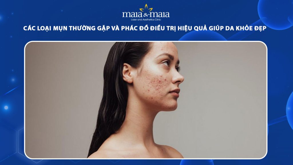 Các loại mụn thường gặp và phác đồ điều trị hiệu quả giúp da khỏe đẹp hơn 1 các loại mụn