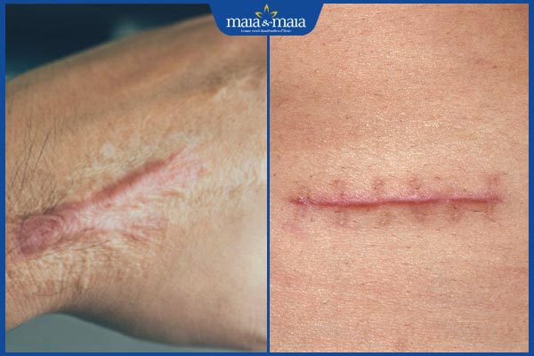 các loại sẹo ngã xe