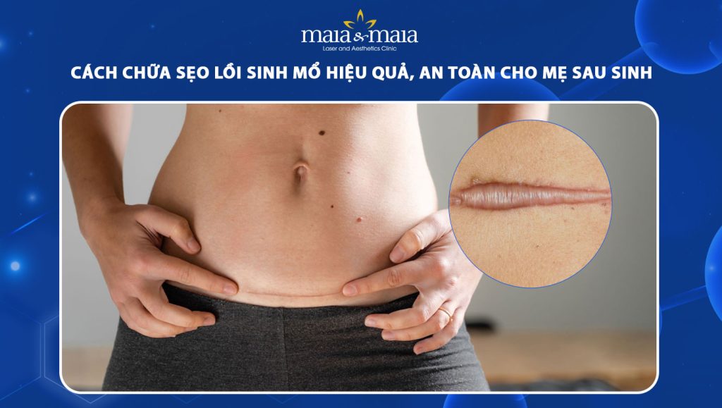 cách chữa sẹo lồi sinh mổ