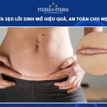 cách chữa sẹo lồi sinh mổ