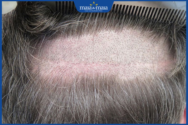 cấy tóc tự thân