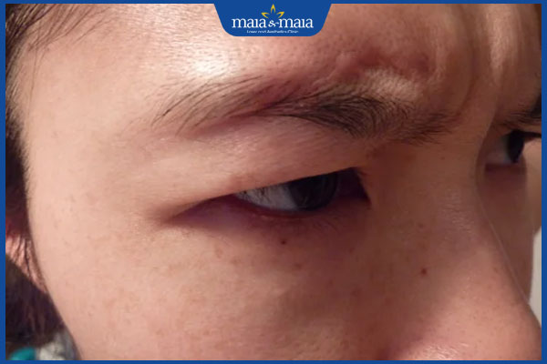 Sẹo ở lông mày nói lên điều gì? Góc nhìn nhân tướng học & thẩm mỹ 3 có sẹo ở lông mày