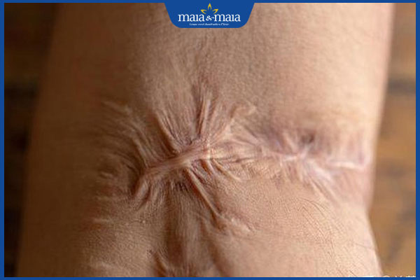 da có sẹo kém đàn hồi