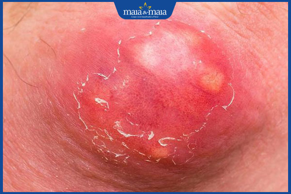 đặc điểm mụn hạch