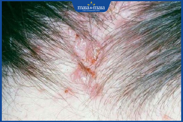 Mụn trứng cá trên da đầu do đâu? Cách điều trị và chăm sóc 2 đặc điểm mụn trên da đầu