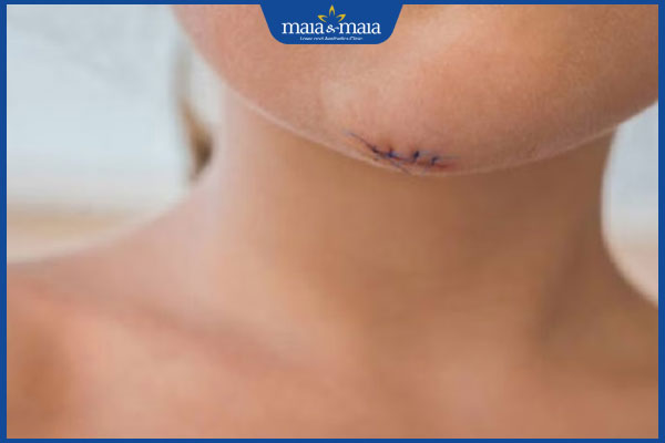 đặc điểm sẹo khâu trên mặt