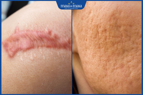 đặc điểm sẹo lâu năm