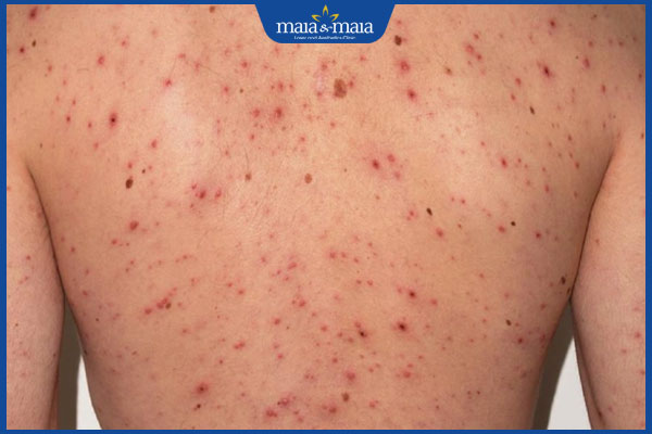 dấu hiệu phát ban mụn trứng cá