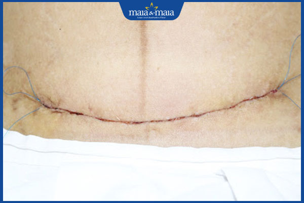 Sẹo mổ lấy thai có nguy hiểm không? Biện pháp làm mờ sẹo 2 giai đoạn viêm