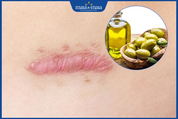 hiệu quả trị sẹo bằng dầu oliu