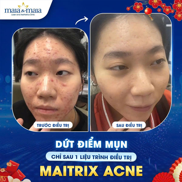 khách hàng chữa mụn tại maia