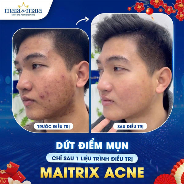 khách hàng trị mụn tại maia