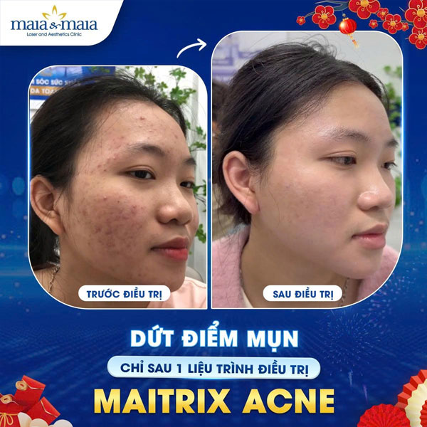 khách trị mụn thành công