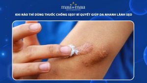 khi nào thì dùng thuốc chống sẹo