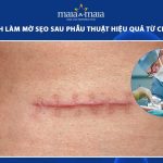 làm mờ sẹo sau phẫu thuật
