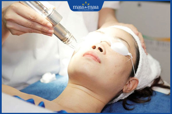 Công nghệ Laser Mixel có tác dụng gì? Quy trình và chi phí thực hiện 3 laser mixel