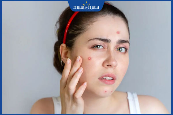 Các loại mụn thường gặp và phác đồ điều trị hiệu quả giúp da khỏe đẹp hơn 2 mặt nổi mụn