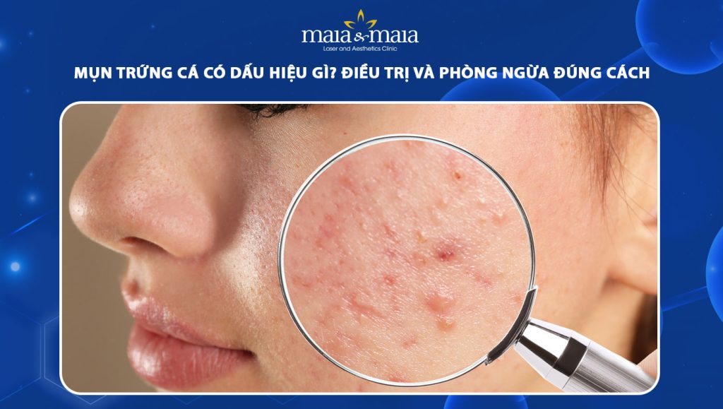Mụn trứng cá có dấu hiệu gì? Điều trị và phòng ngừa đúng cách 1 mụn trứng cá