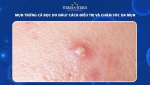 mụn trứng cá bọc