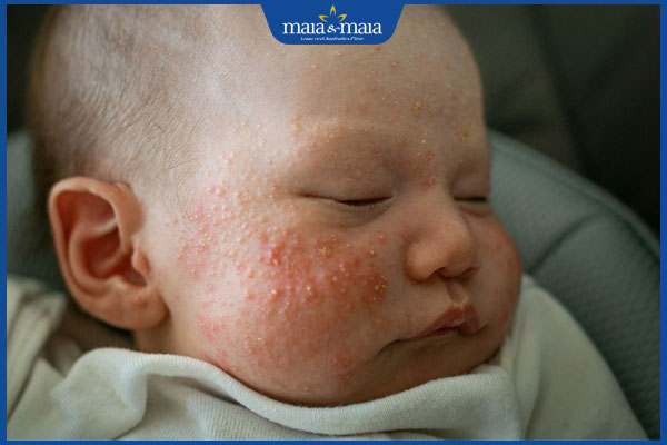 Mụn trứng cá ở trẻ sơ sinh có bình thường không? Cách xử lý an toàn cho bé 4 mụn trứng cá bùng phát ở trẻ