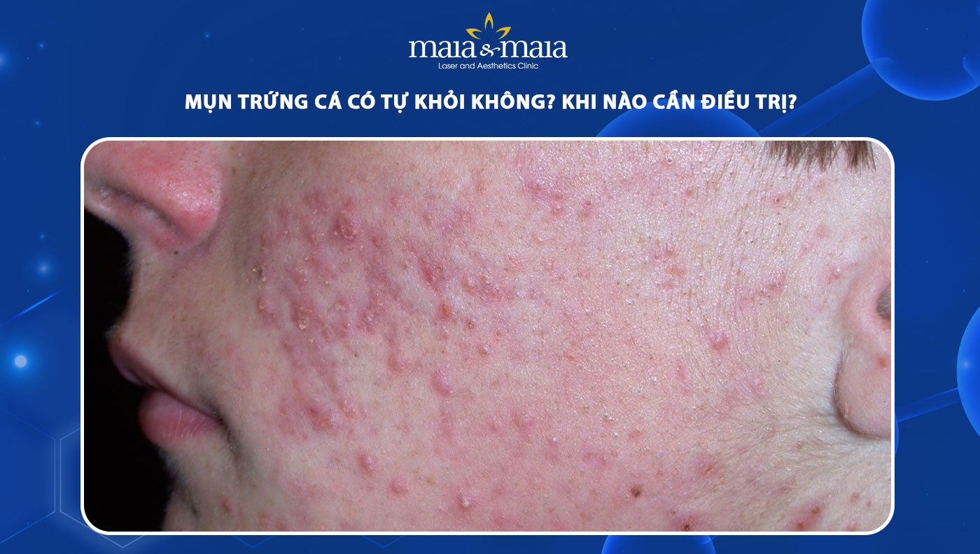 mụn trứng cá có tự khỏi không