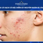 mụn trứng cá hạch