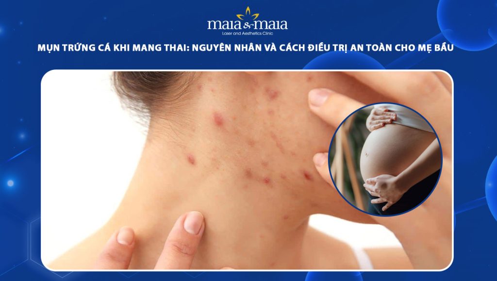 Mụn trứng cá khi mang thai: Nguyên nhân và cách điều trị an toàn cho mẹ bầu 1 mụn trứng cá khi mang thai