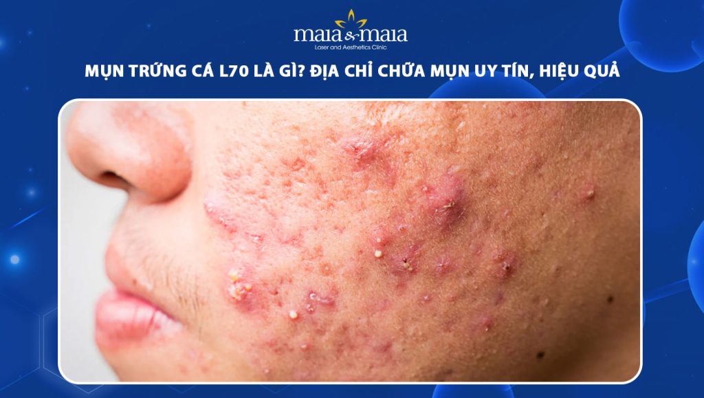 Mụn trứng cá L70 là gì? Địa chỉ chữa mụn uy tín, hiệu quả 1 mụn trứng cá l70