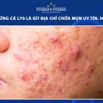 mụn trứng cá l70