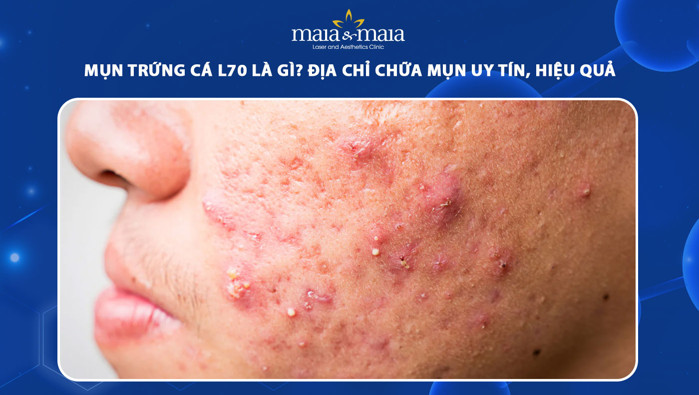 mụn trứng cá l70