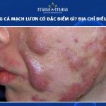 mụn trứng cá mạch lươn