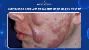 mụn trứng cá mạch lươn