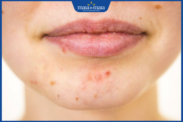 Mụn trứng cá ở cằm do đâu? Làm sao để điều trị và phòng ngừa hiệu quả 2 mụn trứng cá mọc ở cằm