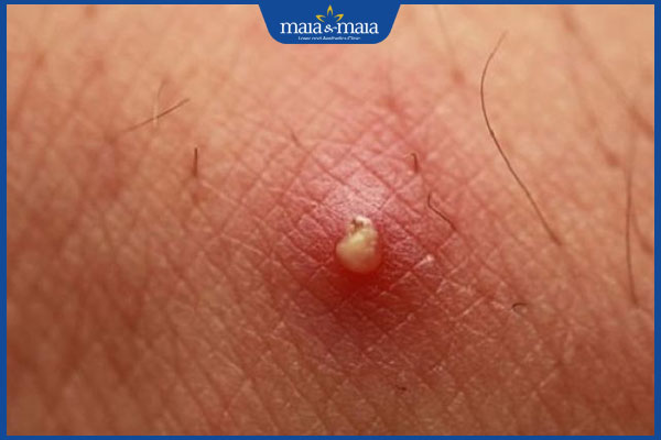 Mụn trứng cá ở vùng kín có dấu hiệu gì? Cách phân biệt và điều trị 3 mụn trứng cá nhiễm trùng