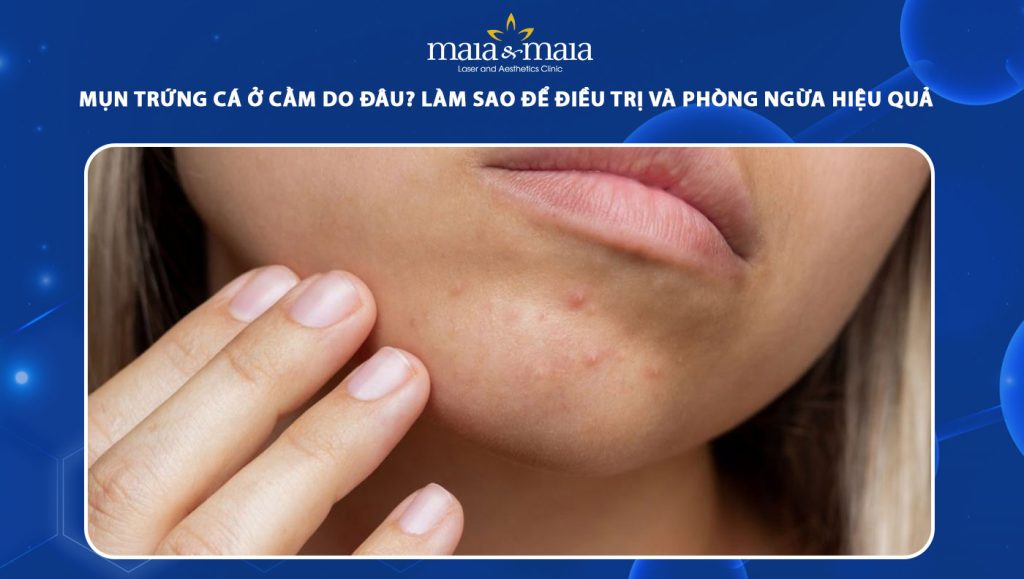 Mụn trứng cá ở cằm do đâu? Làm sao để điều trị và phòng ngừa hiệu quả 1 mụn trứng cá ở cằm