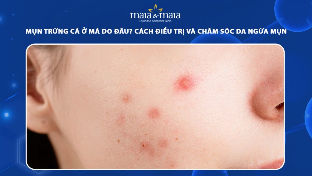 Mụn trứng cá ở má do đâu? Cách điều trị và chăm sóc da 1 mụn trứng cá ở má